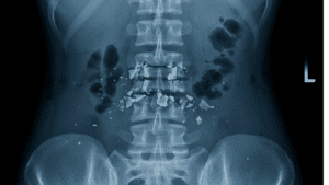 Back Injuries from Lifting Packages: FedEx’s Safety Obligations in Tampa Bay